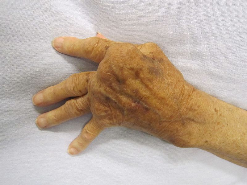 Rheumatoid_Arthritis
