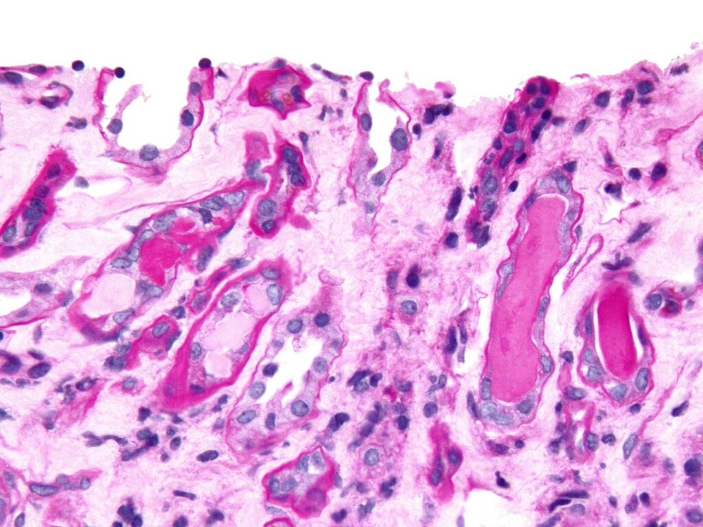 1440px-Cast_nephropathy_-_2_cropped_-_very_high_mag