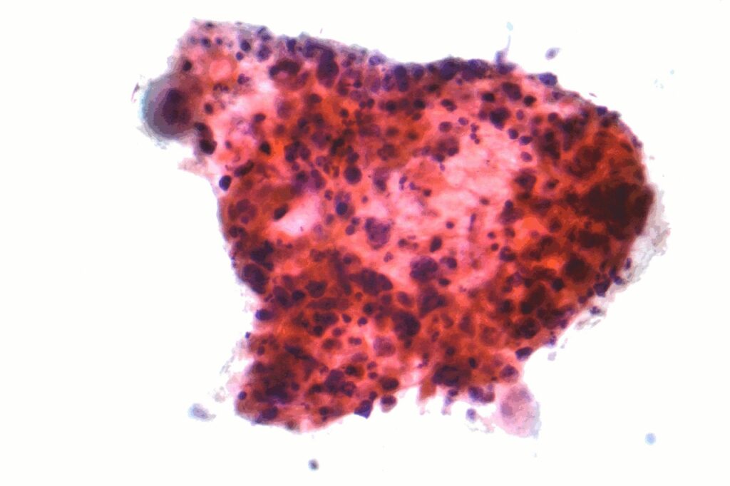 1620px-Squamous_carcinoma_lung_cytology