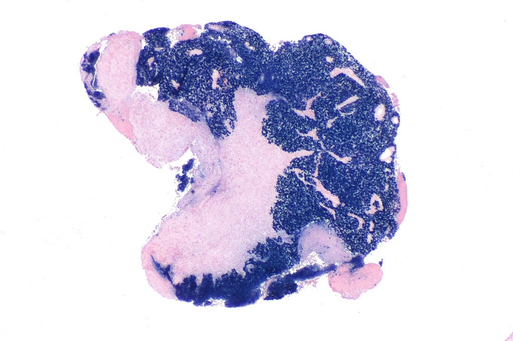 1620px-Nasopharyngeal_carcinoma_-_EBER_--_very_low_mag