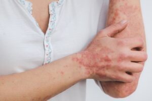 Azitra’s ATR-04 receives FDA fast track status for treating skin rash