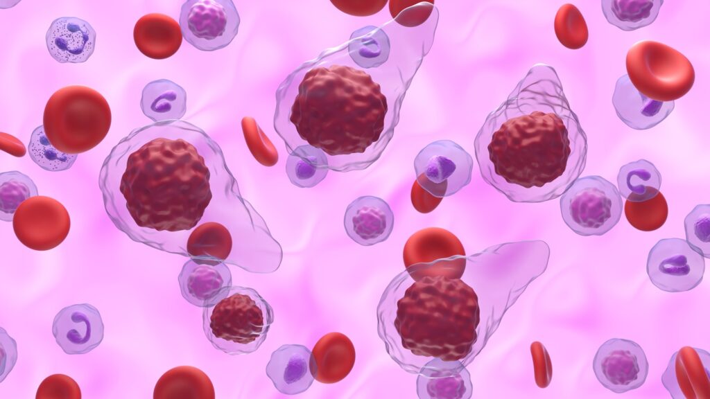 Myelofibrosis is a rare blood cancer causing bone marrow scarring, severe fatigue, anaemia, and enlarged spleen. Credit: Nemes Laszlo / Shutterstock.com.