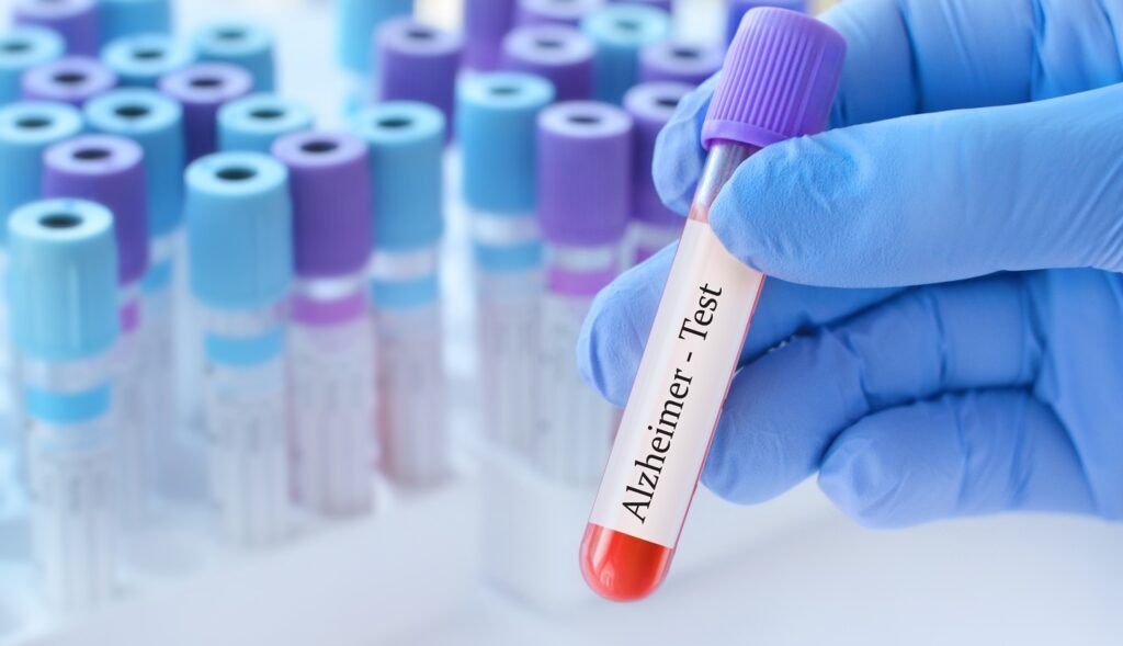 Alzheimer’s disease is characterised by amyloid beta and tau pathologies, driven by ongoing neurotoxicity from protofibrils. Credit: StanislavSukhin / Shutterstock.com.