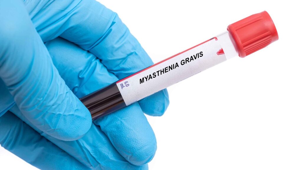 Myasthenia,Gravis.,Myasthenia,Gravis,Disease,Blood,Test,In,Doctor,Hand
