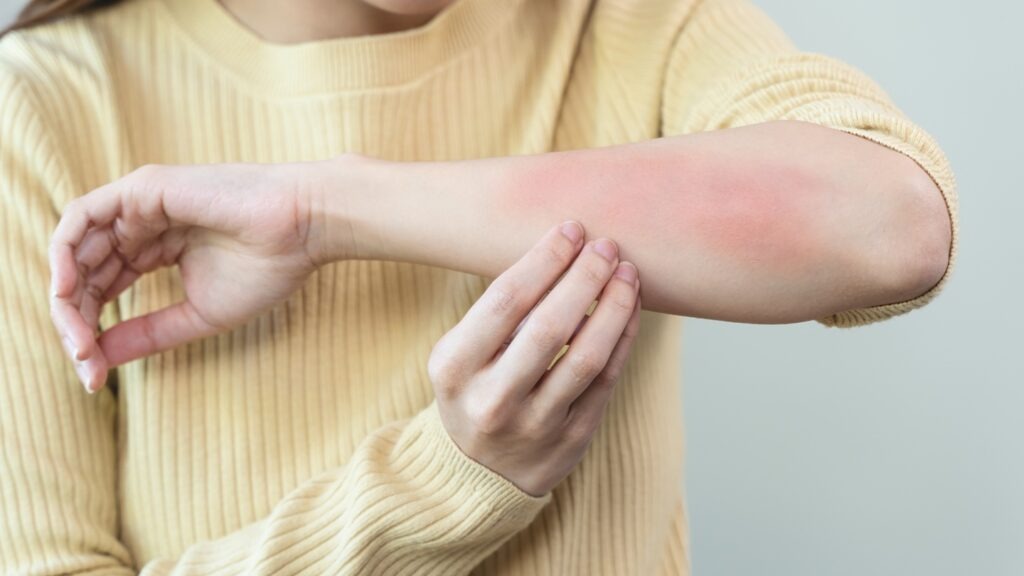 CSU is a chronic skin disease driven partly by type 2 inflammation, leading to severe itching and hives. Credit: Pormezz / Shutterstock.com.