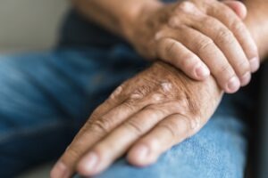 FDA accepts Sun Pharma’s Ilumya sBLA for psoriatic arthritis