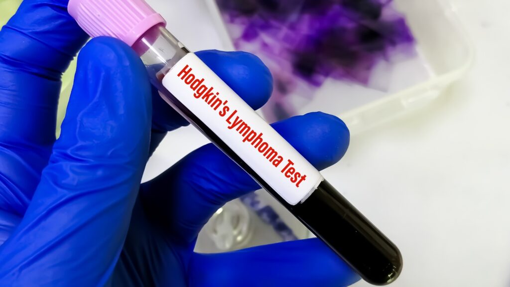 Blood,Sample,For,Hodgkin's,Lymphoma,Test,,A,Type,Of,Cancer