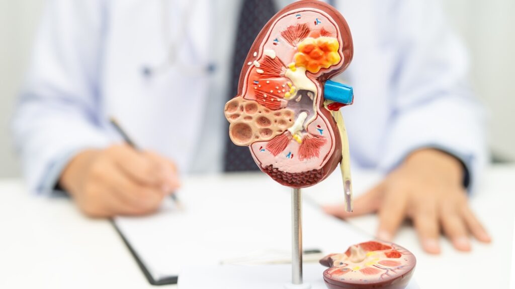 Kidney,Disease,,Chronic,Kidney,Disease,Ckd,,Doctor,Hold,Human,Model