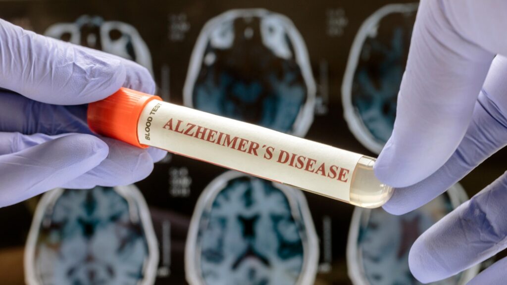 Auvelity is intended to treat agitation associated with dementia due to Alzheimer’s. Credit: digicomphoto / Shutterstock.com.