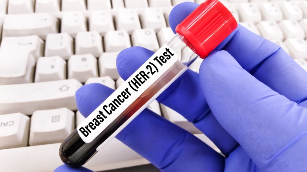 Blood,Sample,For,Her-2,Breast,Cancer,Testing,,Human,Epidermal,Growth