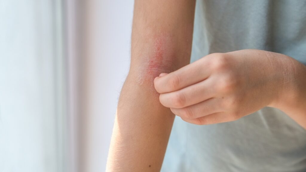 A,Girl,Scratches,The,Skin,On,The,Elbow,Of,Her