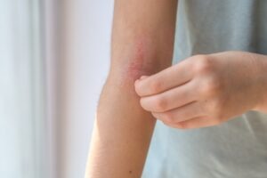 ALK’s EURneffy secures MHRA approval for anaphylaxis treatment