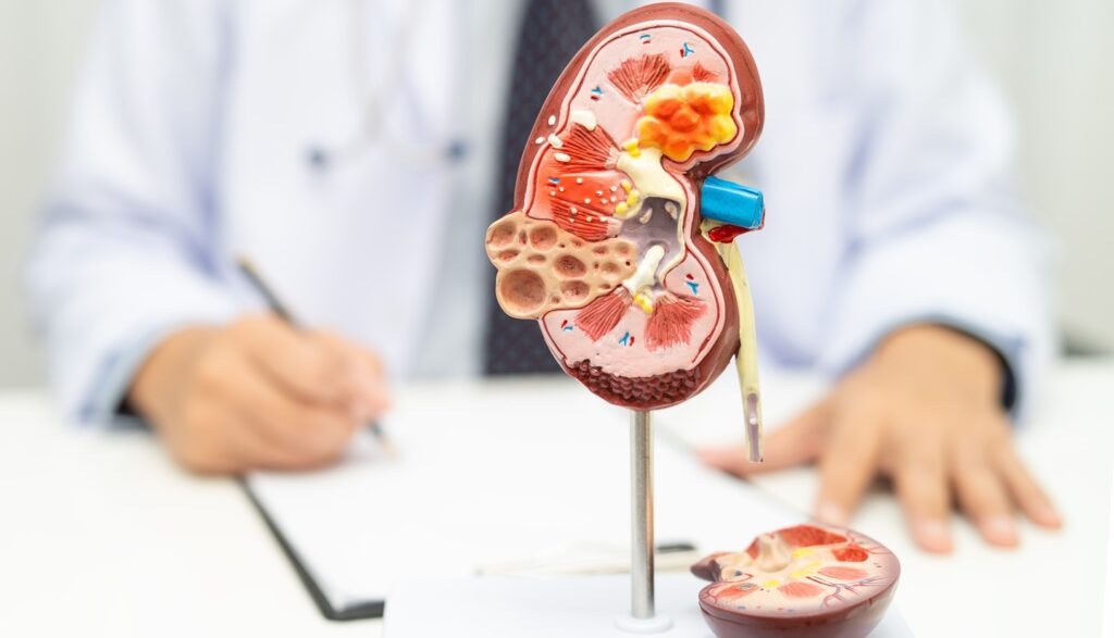 pMN is a chronic autoimmune disease that can result in kidney damage and may progress to kidney failure. Credit: sasirin pamai / Shutterstock.com.