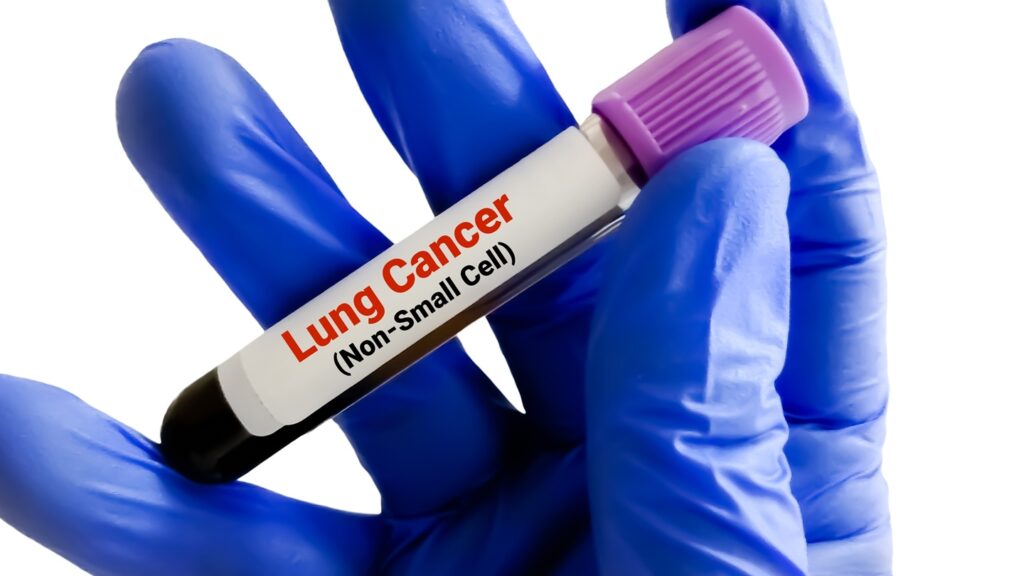 The HARMONi-6 trial included patients with locally advanced or metastatic squamous NSCLC, regardless of PD-L1 expression. Credit: Saiful52 / Shutterstock.com.