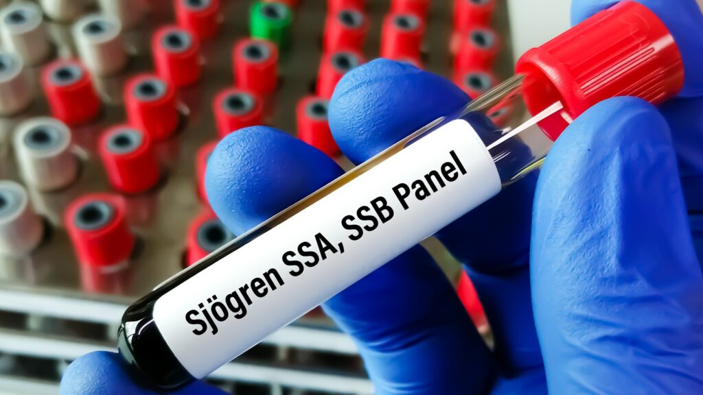 Blood,Sample,For,Sjogren's,Antibody,Tesr.,Sjogren,Ssa,,Ssb.